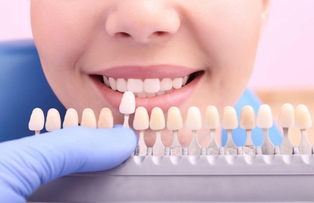 Tooth Coloured Fillings In Hyderabad