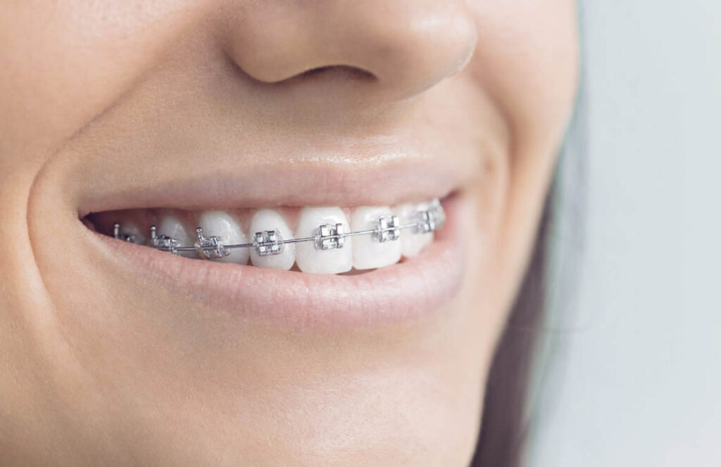 Dental Braces In Hyderabad