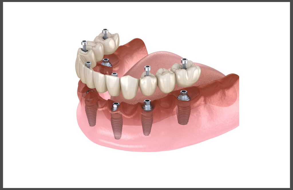 Immediate Dental Implants In Hyderabad