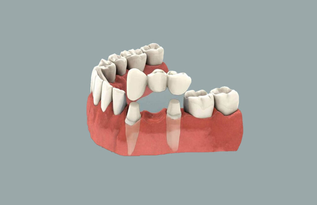 Dental Crowns in Hyderabad