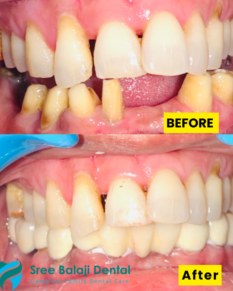 Dental Crowns In Hyderabad