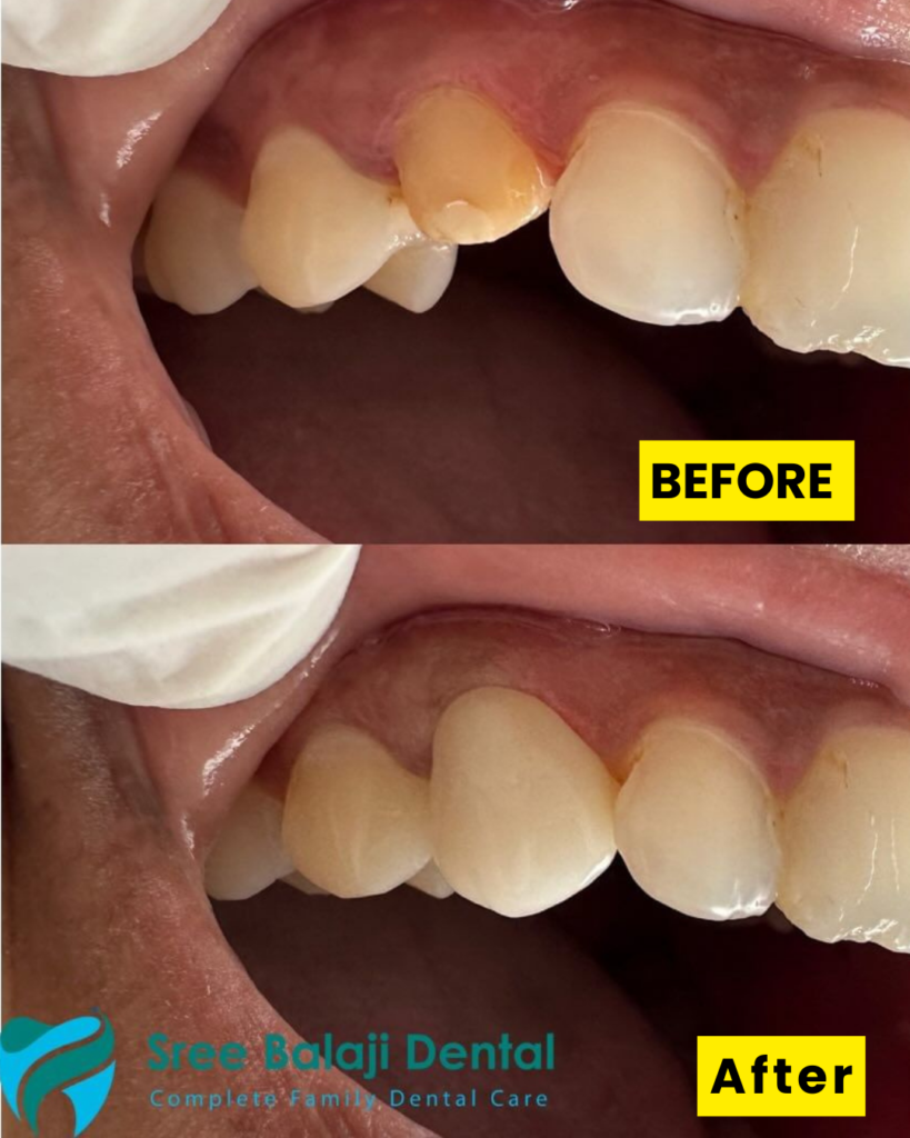 Dental Crowns in Hyderabad