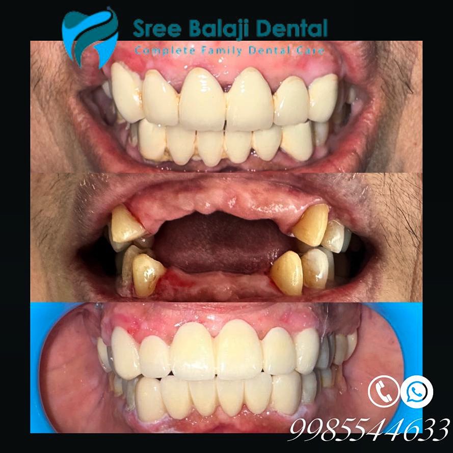 Smile Designing in Hyderabad