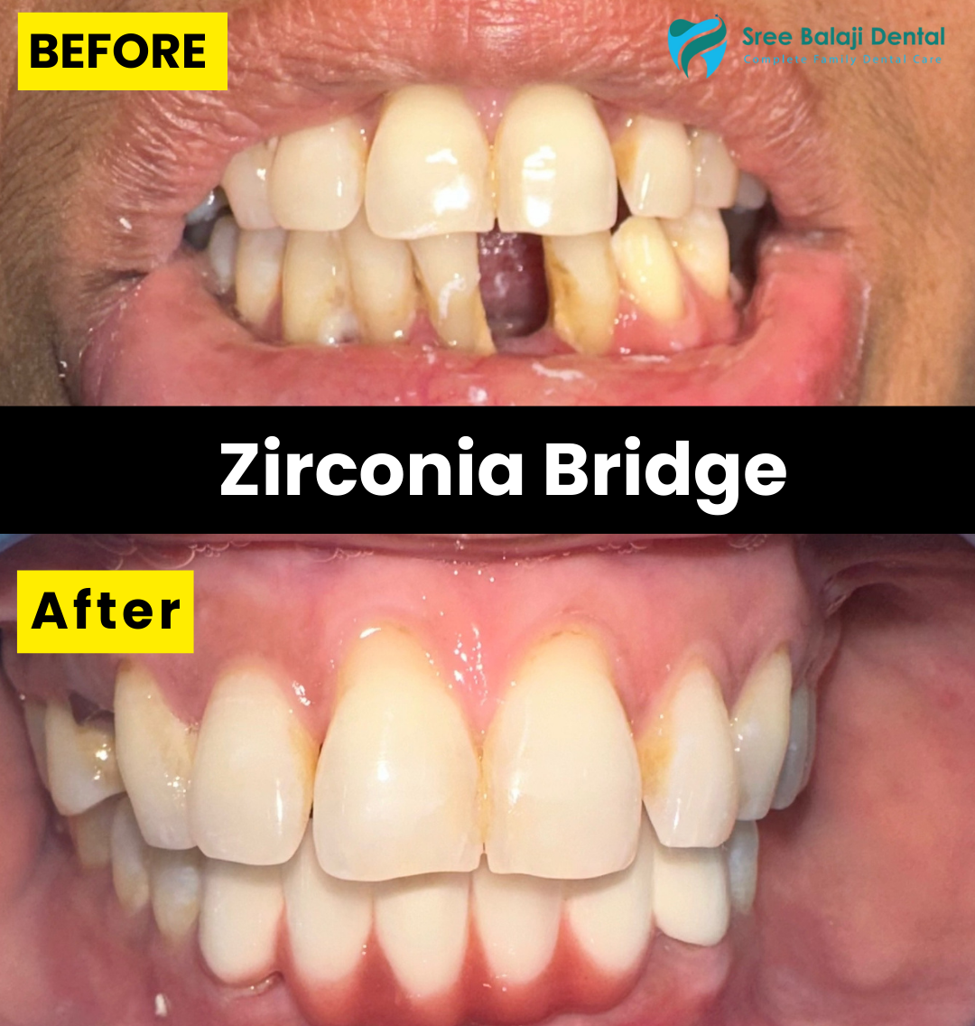 Zirconia Bridge In Hyderabad
