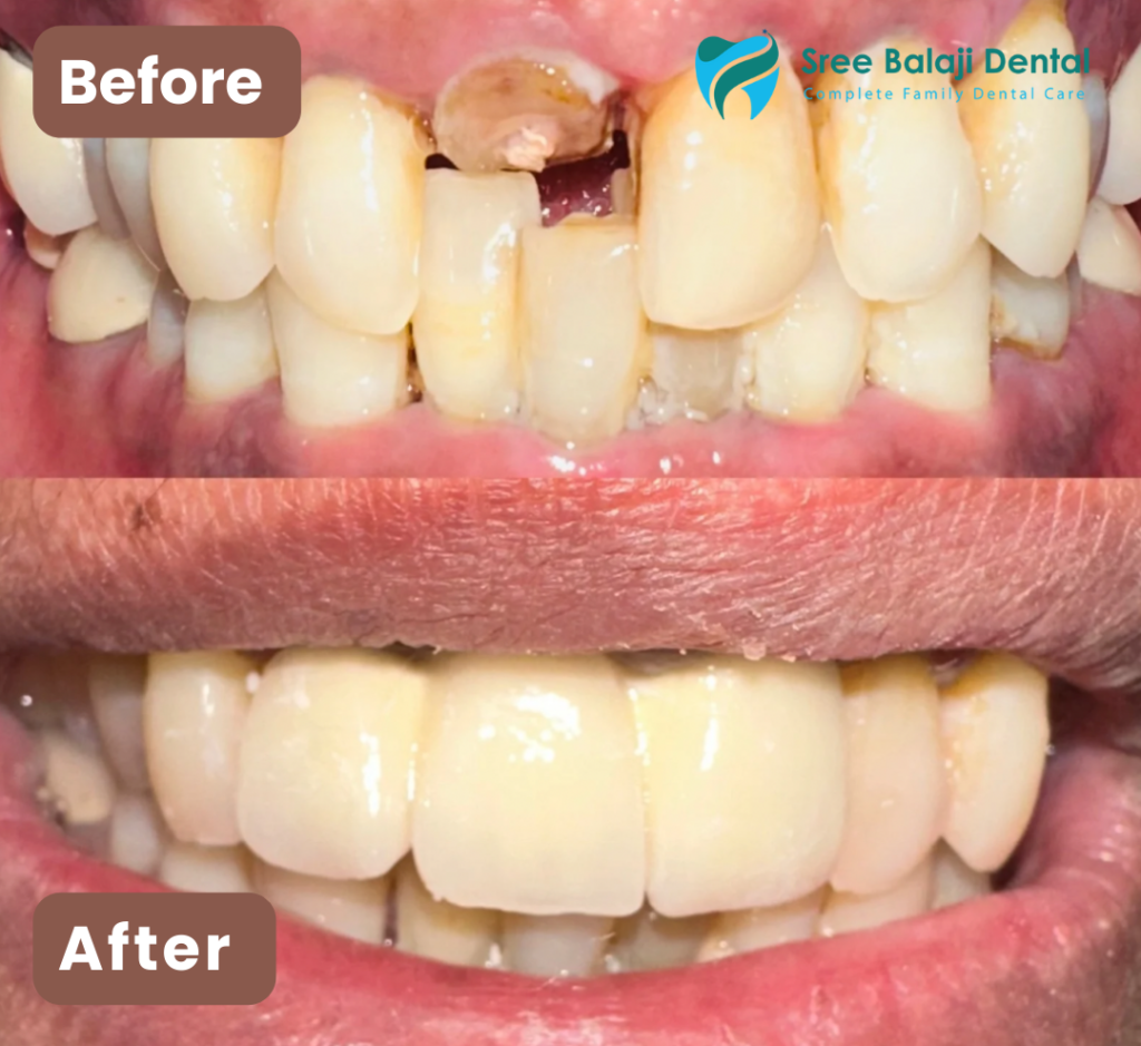 Zirconia Crowns in Hyderabad