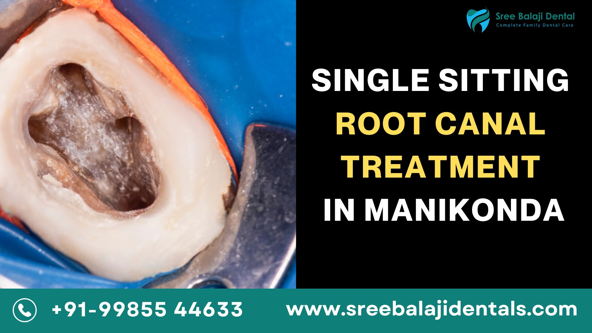 Single Sitting Root Canal Treatment In Manikonda