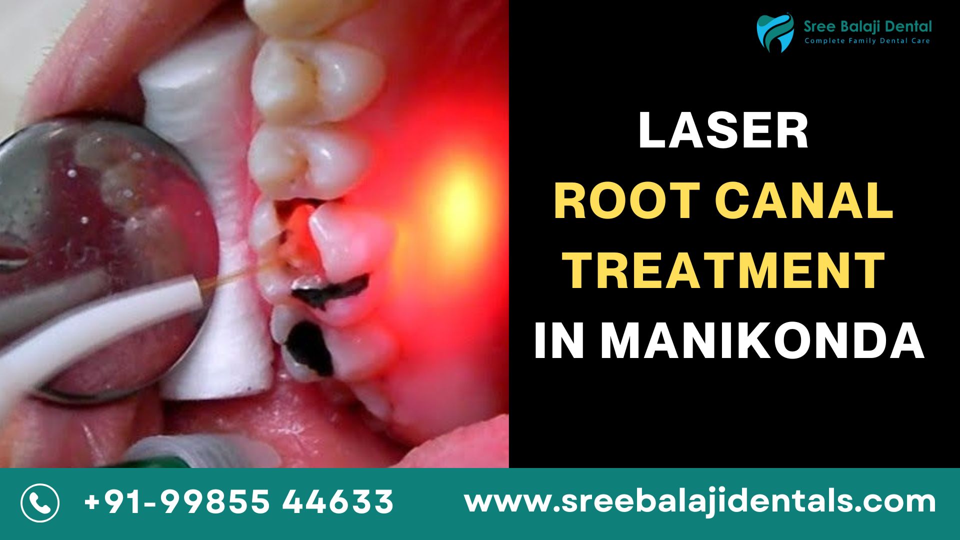 Laser Root Canal Treatment In Hyderabad 