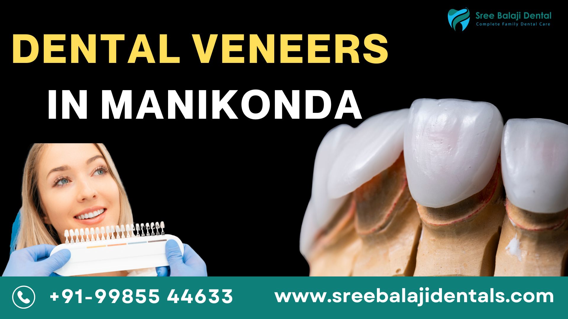 Dental Veneers In Manikonda 