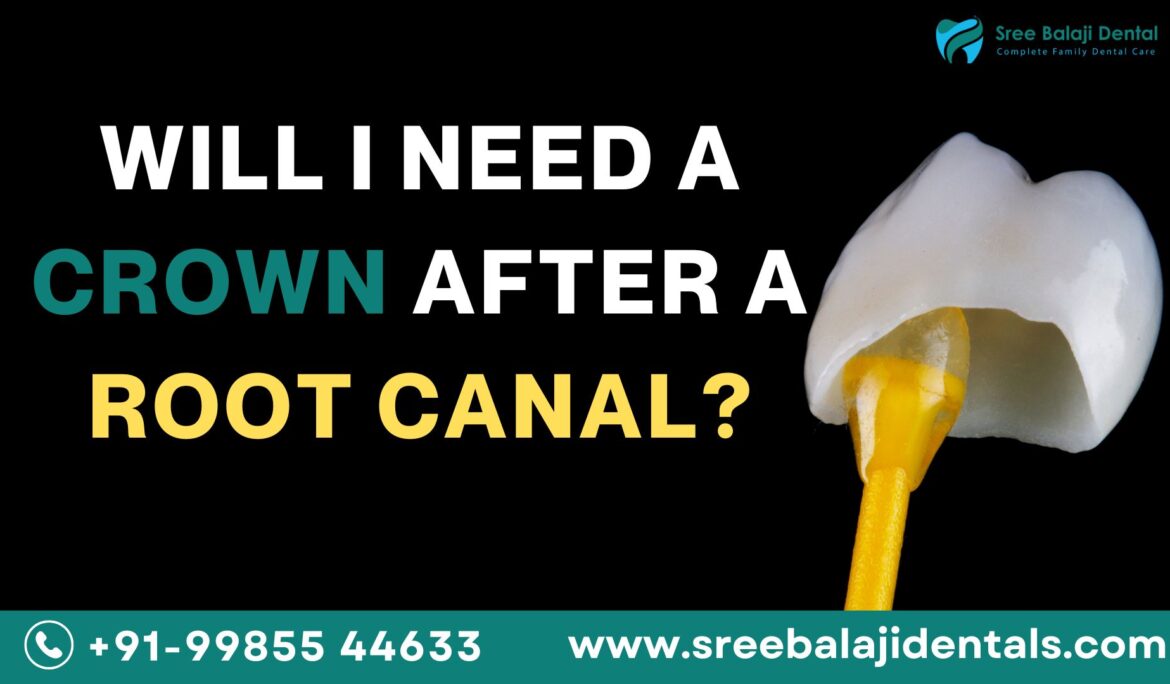 Will I Need a Crown After a Root Canal?